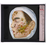 Maladies de la peau causées par des microbes. Impétigo de la face.