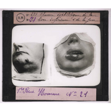 Les Maladies vénériennes. Chancre syphilitique de la lèvre inférieure et de la face.