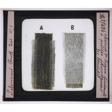 Les Maladies du cuir chevelu. Cheveux de teigne tondante à petites spores.