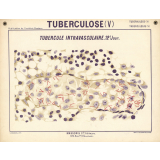 Tuberculose (V). Tubercule intravasculaire. 12e jour.