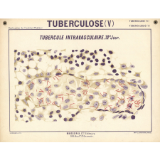 Tuberculose (V). Tubercule intravasculaire. 12e jour.