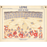 Lèpre. Coupe de peau.