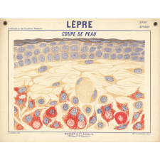 Lèpre. Coupe de peau.