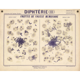 Diphtérie (III). Frottis de fausse membrane.