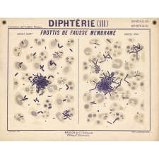 Diphtérie (III). Frottis de fausse membrane.