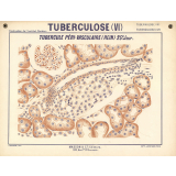 Tuberculose (VI). Tubercule péri-vasculaire (Rein). 25e jour.