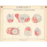 Cancer. Evolution de l'archoplasma.