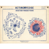Actinomycose. Réaction phagocytaire.