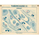 Tuberculose (IX). Crachat.