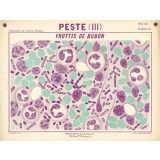Peste (III). Frottis de bubon.