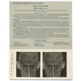 193. Dura Mater. The Edinburgh Stereoscopic Atlas of Anatomy. Head and Neck. Spinal canal - N°1.