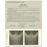 120. Shoulder from behind. The Edinburgh Stereoscopic Atlas of Anatomy. Upper Limb. Surface anatomy - N°3. Upper part of the back. 