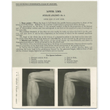 208. Outer side of left Knee. The Edinburgh Stereoscopic Atlas of Anatomy. Lower limb. Surface anatomy - N°4.