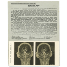 195. Brain Stem and Cranial Nerves in situ. The Edinburgh Stereoscopic Atlas of Anatomy. Head and Neck. Spinal canal - N°3.
