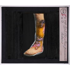 Maladies de la peau causées par des microbes. Syphilides ulcéro-gommeuses tertiaires.