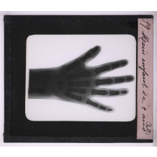 La Radiographie appliquée aux Sciences médicales. Main, enfant de 2 ans.