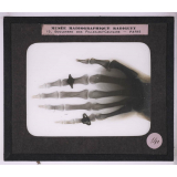 La Radiographie appliquée aux Sciences médicales. Main avec fragments d'aiguilles. 