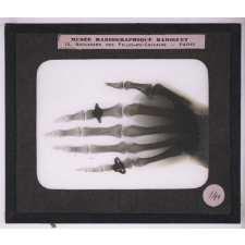 La Radiographie appliquée aux Sciences médicales. Main avec fragments d'aiguilles.