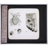 Maladies de la peau causées par des microbes. 1° Pied atteint de deux boutons d'Orient; 2° Une punaise; 3° leischmania tropica.