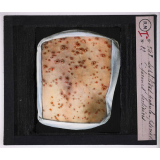 Maladies de la peau causées par des microbes. Syphilides papulo-psoriasiformes tertiaires.