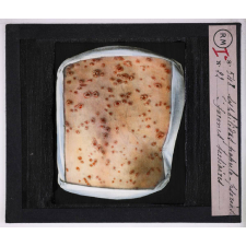 Maladies de la peau causées par des microbes. Syphilides papulo-psoriasiformes tertiaires.