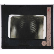 La Tuberculose. Signes prémonitoires de tuberculose (radiographie).