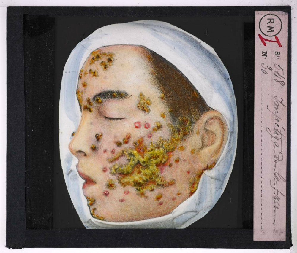 Maladies de la peau causées par des microbes. Impétigo de la face.