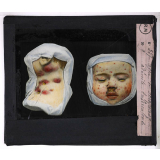 Prophylaxie des maladies contagieuses. 1ère série. Transmises par les déjections, les matières fécales, l'eau souillée; les sécrétions respiratoire. Type de scrofuleux, adénite tuberculeuse.