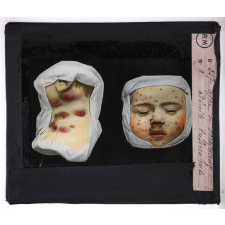 Prophylaxie des maladies contagieuses. 1ère série. Transmises par les déjections, les matières fécales, l'eau souillée; les sécrétions respiratoire. Type de scrofuleux, adénite tuberculeuse.