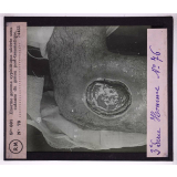 Conférence antivénérienne faite à des officiers et soldats. 3ème Série. Énorme gomme syphilitique ulcérée sous cutanée du genou post-traumatique.