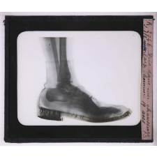 La Radiographie appliquée aux Sciences médicales. Pied dans une chaussure large, homme 19 ans.