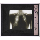 La Tuberculose. Poumons sains. Radio.
