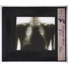 La Tuberculose. Poumons sains. Radio.