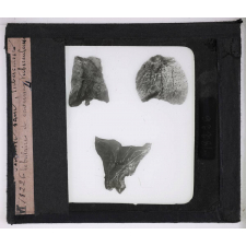 La Tuberculose. Poumon sain, tuberculose lobulaire et caverne tuberculeuse.