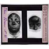 Conférence antivénérienne faite à des officiers et soldats. 3ème Série. Syphilis osseuse, gommes encore fermées du front.