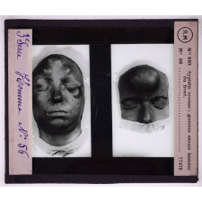 Conférence antivénérienne faite à des officiers et soldats. 3ème Série. Syphilis osseuse, gommes encore fermées du front.