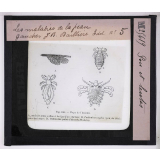 Les Maladies du cuir chevelu. Poux et lentes.
