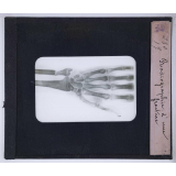 La Photographie et ses applications. Radiographie d'une fracture.