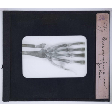 La Photographie et ses applications. Radiographie d'une fracture.