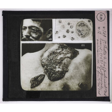 Maladies de la peau causées par des parasites. 2e série: insectes et champignons. 1° Frottis de pus contenant des levures; 2° et 3° blastomycose américaine de la face et du dos.