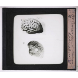 La Tuberculose. Cerveau sain et cerveau tuberculeux.