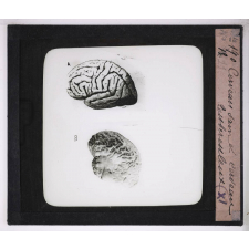 La Tuberculose. Cerveau sain et cerveau tuberculeux.