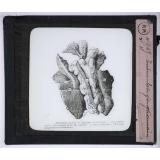 La Tuberculose, maladie sociale. Tuberculose ganglionnaire.
