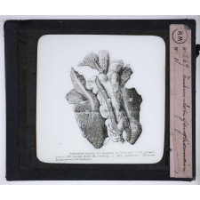 La Tuberculose, maladie sociale. Tuberculose ganglionnaire.