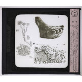 Maladies de la peau causées par des parasites. 2e série: insectes et champignons. 1° Pied de Madura (provenance Madagascar); 2° Lésion montrant le parasites; 3° le parasite.