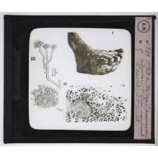 Maladies de la peau causées par des parasites. 2e série: insectes et champignons. 1° Pied de Madura (provenance Madagascar); 2° Lésion montrant le parasites; 3° le parasite.