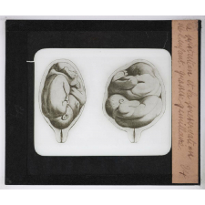 La Protection et la préservation de l'enfant avant sa naissance. Grossesse gémellaire.