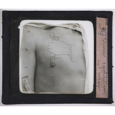 Les Maladies vénériennes. Chancre syphilitique du tatouage.