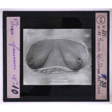 Conférence antivénérienne faite à des ouvrières. 1ère Série. Chancre syphilitique des seins.