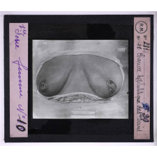Conférence antivénérienne faite à des ouvrières. 1ère Série. Chancre syphilitique des seins.